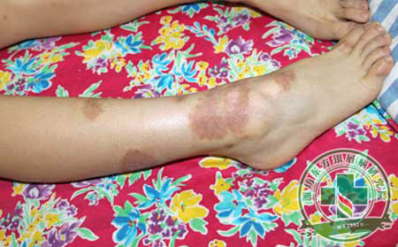 牛皮癬常識(shí)