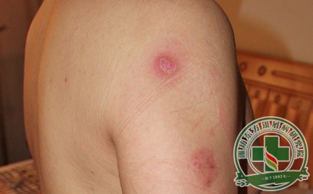 電腦輻射對牛皮癬有沒有危害呢