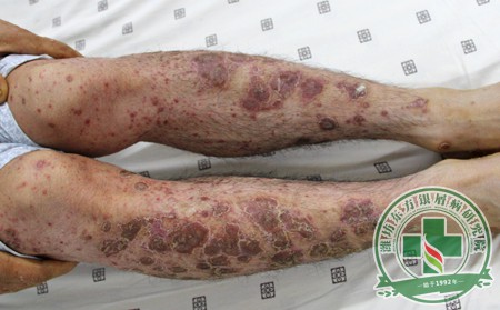 關節型銀屑病的護理常識有哪些