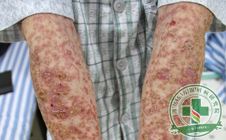 尋常型銀屑病如何預防才有效果呢