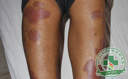 銀屑病,關節型銀屑病,銀屑病預防