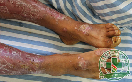 銀屑病,關(guān)節(jié)型銀屑病,銀屑病病因