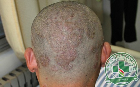 日常生活中如何預(yù)防牛皮癬可以呢