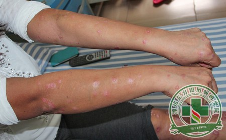 銀屑病患者如何做好日常的護理工作呢