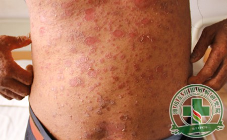 銀屑病在早期治療的時候需要注意什么呢