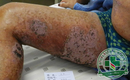 銀屑病,護理,銀屑病病情