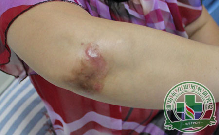 銀屑病,關節型銀屑病,銀屑病癥狀