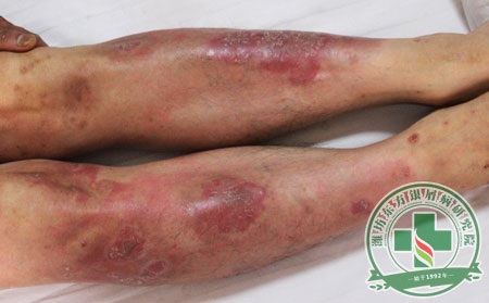 銀屑病,銀屑病患者,飲食