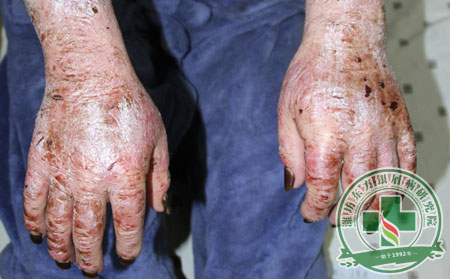 銀屑病,膿皰型銀屑病,癥狀