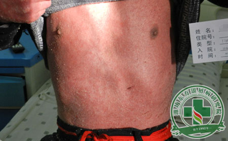 銀屑病,全身銀屑病,癥狀