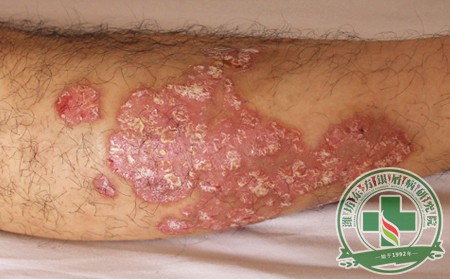 銀屑病,膿皰型銀屑病,癥狀