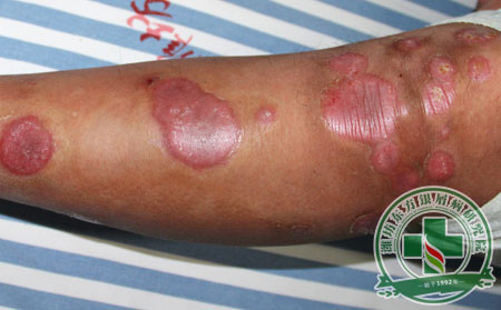 銀屑病,紅皮型銀屑病,治療