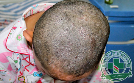 兒童,銀屑病,護理