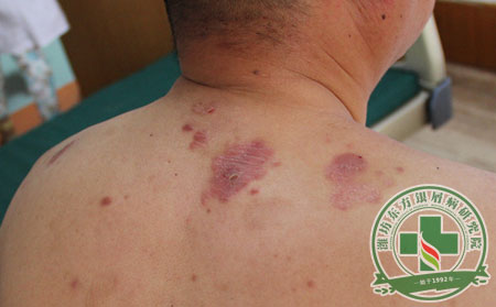 銀屑病,發病原因,發病因素