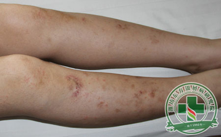 銀屑病,睡眠,護理