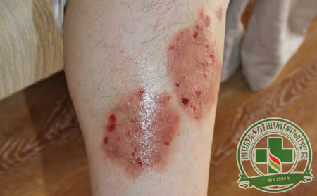 銀屑病,紅皮型銀屑病,治療