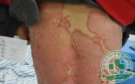 銀屑病,復(fù)發(fā),原因