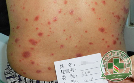 濰坊,銀屑病,治療