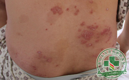 銀屑病,全身銀屑病,癥狀