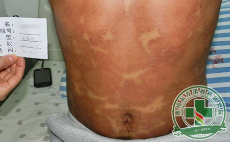 銀屑病,治療,治療要點