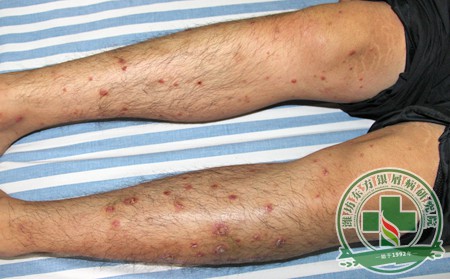 銀屑病,治療,銀屑病治療