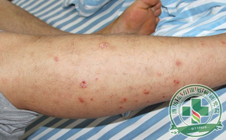 銀屑病,飲食,銀屑病患者