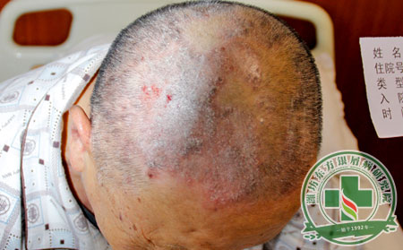 銀屑病,臉部,治療