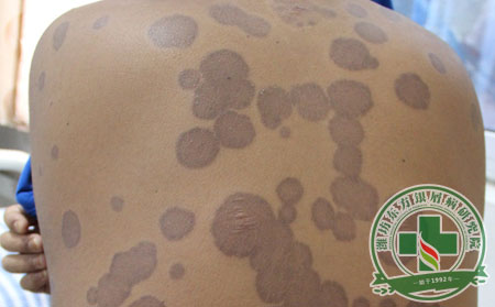 銀屑病,治療,治療銀屑病