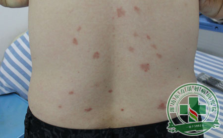 銀屑病,秋乏,睡眠