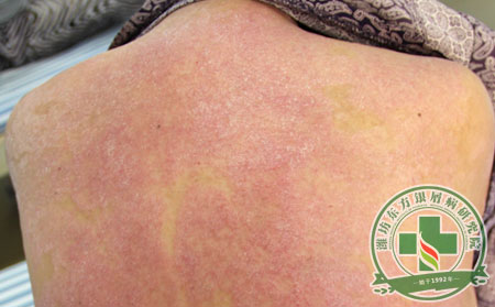 銀屑病,治療,治療銀屑病