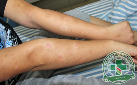 銀屑病,調(diào)整,心態(tài)