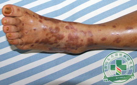 腳部,銀屑病,護(hù)理