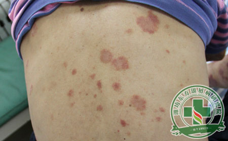 秋天,銀屑病,復發(fā)