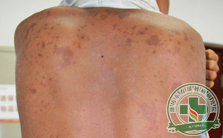 銀屑病,發病率,預防