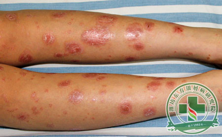 秋季如何預防銀屑病復發?