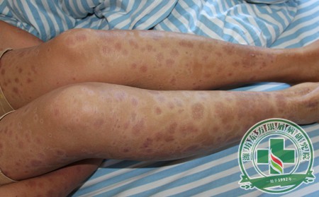 銀屑病,治療,注意