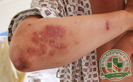 牛皮癬,癥狀,類型