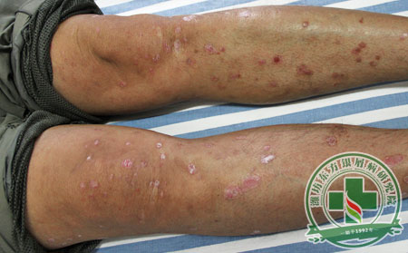 老年牛皮癬,牛皮癬怎么治療,老年牛皮癬注意什么