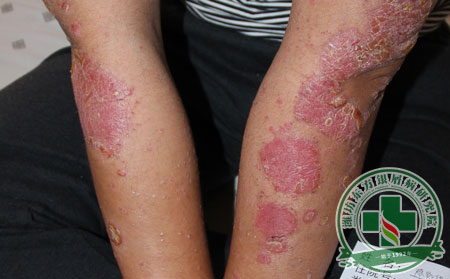 牛皮癬復發(fā),牛皮癬患者忌煙,牛皮癬護理