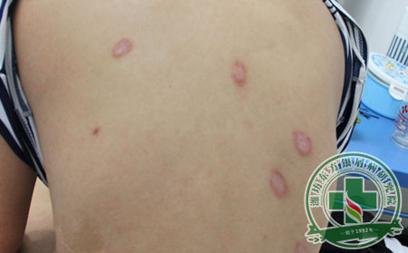 牛皮癬護理,牛皮癬注意事項,生活習慣