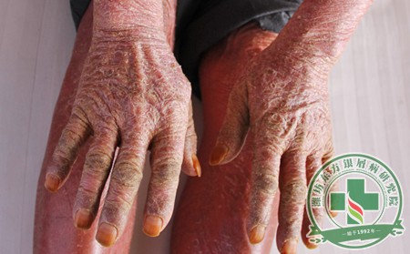 老年牛皮癬,牛皮癬護理,老年牛皮癬護理