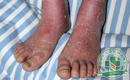 關節(jié)型牛皮癬,預防牛皮癬,預防關節(jié)型牛皮癬