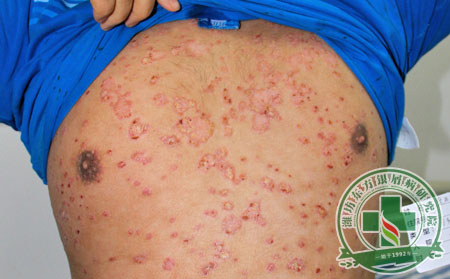 治療銀屑病的方法