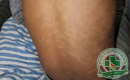 牛皮癬哪種治療方法可以