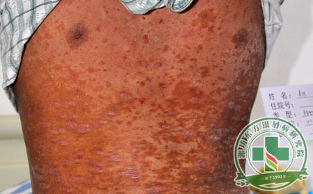 濰坊治療銀屑病效果哪里可以