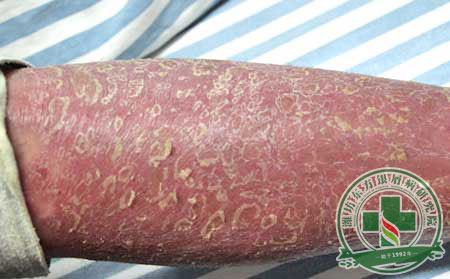 濰坊治療牛皮癬的醫院哪里可以點