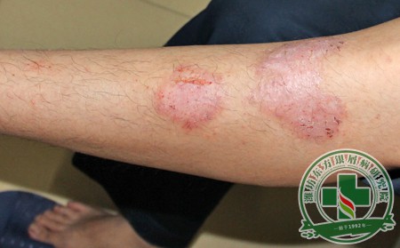 尋常型銀屑病怎么發生的