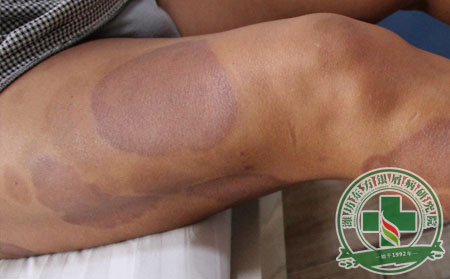 濰坊銀屑病患者冬季復發去哪治療