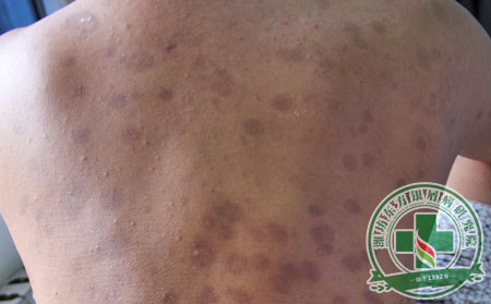 濰坊銀康醫院治療銀屑病怎么樣