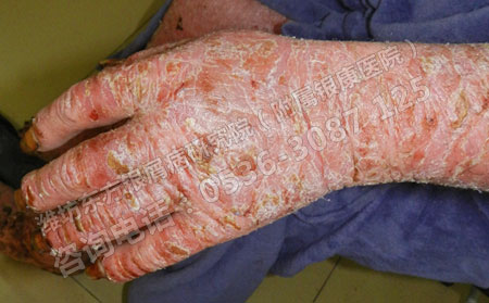 牛皮癬關節炎冬季如何做好關節護理